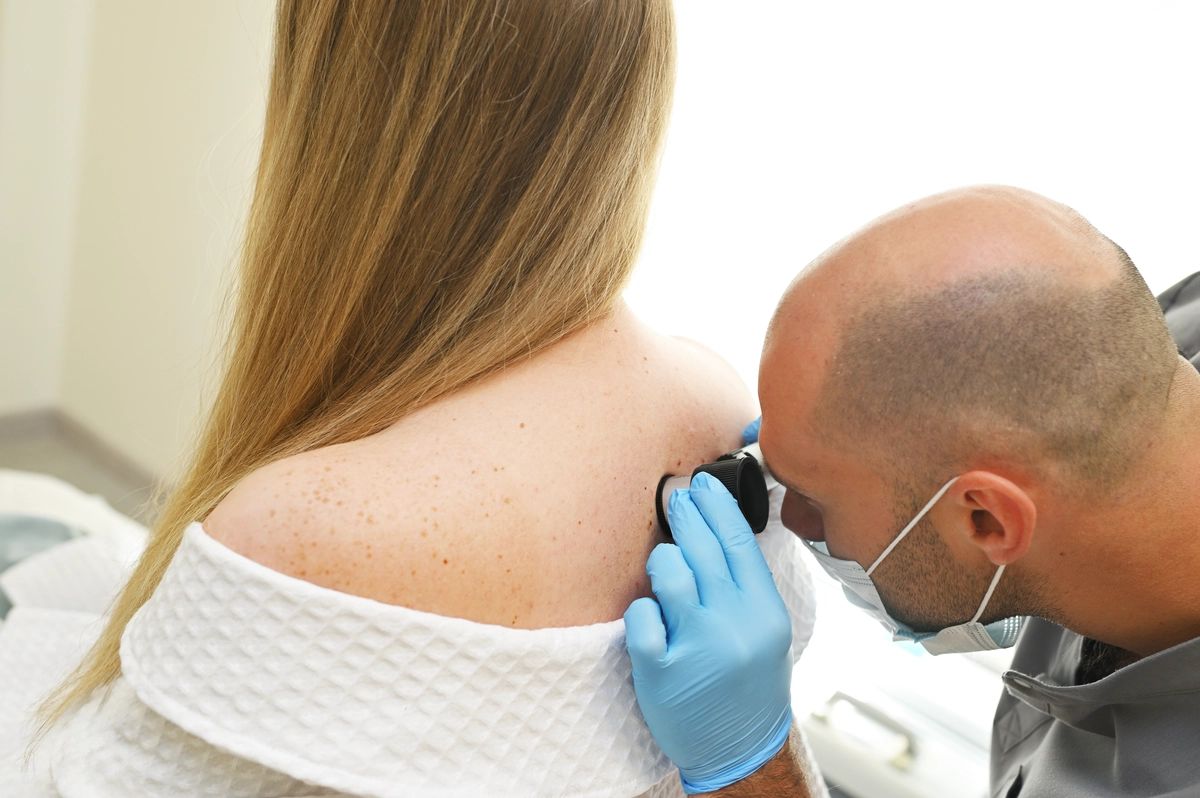 Laser Dark Spot Removal in Fountain Valley, CA
