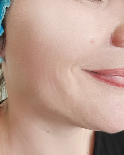 dermal fillers before