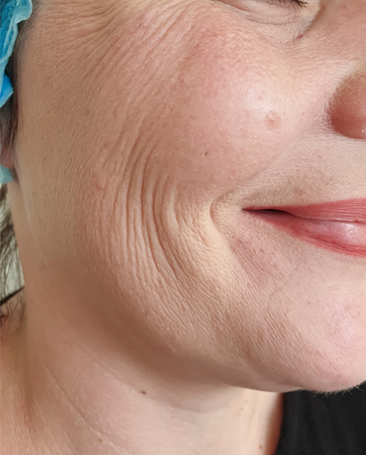 dermal fillers before