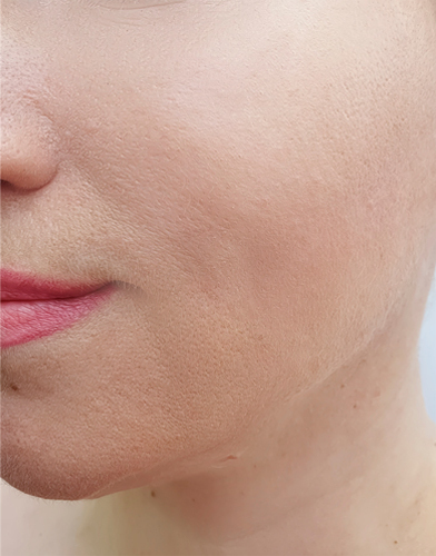 skin resurfacing after