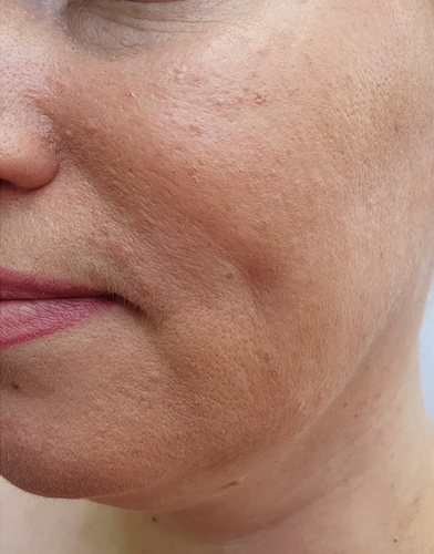 skin resurfacing before