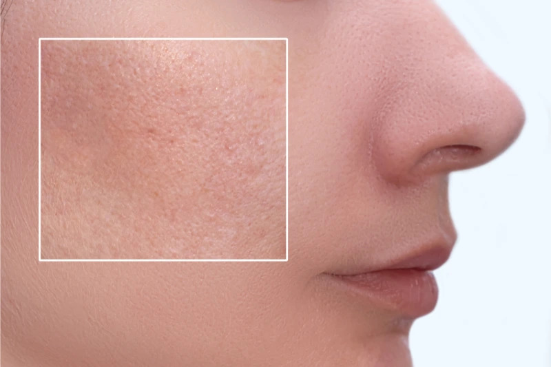 sublative rf skin resurfacing​