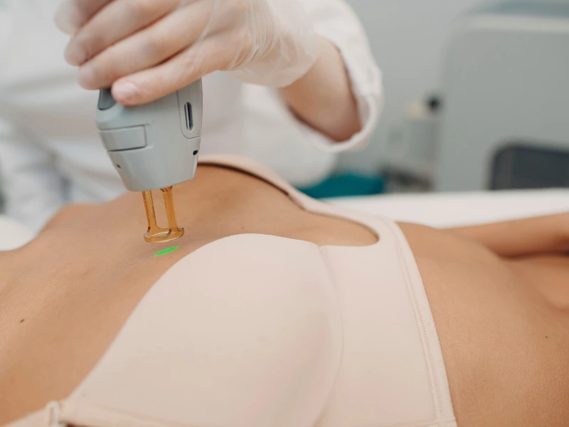 Laser hair removal safety