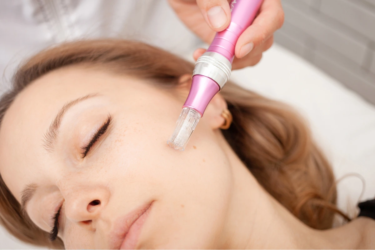 Microneedling benefits
