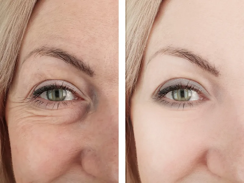 microneedling skin tightening